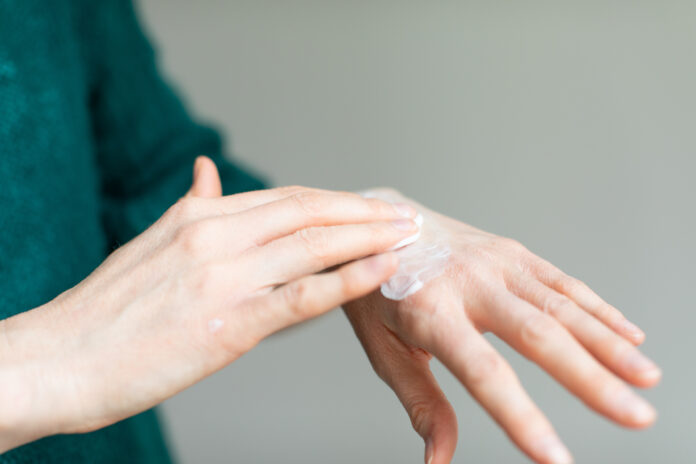Woman applying hand cream to relieve the dry skin caused by hand sanitizer