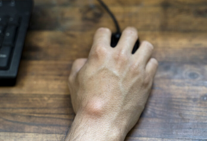 Ganglion cyst on man's hand. Hand holding computer mouse