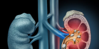 Added sugar may increase the risk of kidney stones