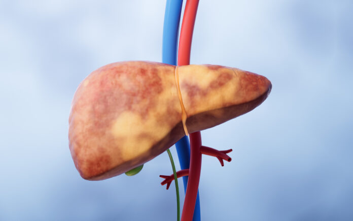 Liver organ with fatty liver state, 3d rendering. Fatty Liver Disease