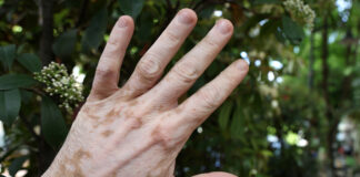 vitiligo