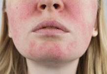 rosacea