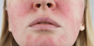 rosacea