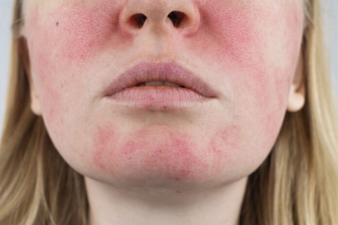 rosacea