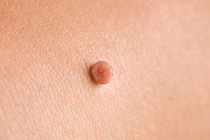 at-home skin tag remover