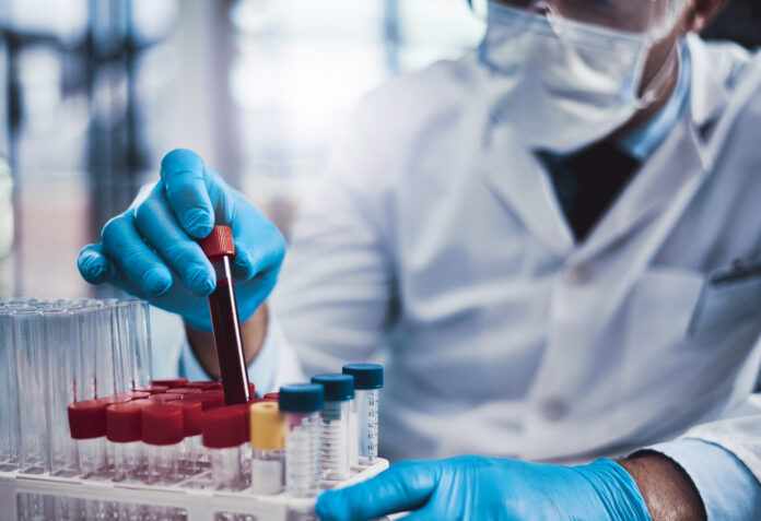 Alzheimer's blood test
